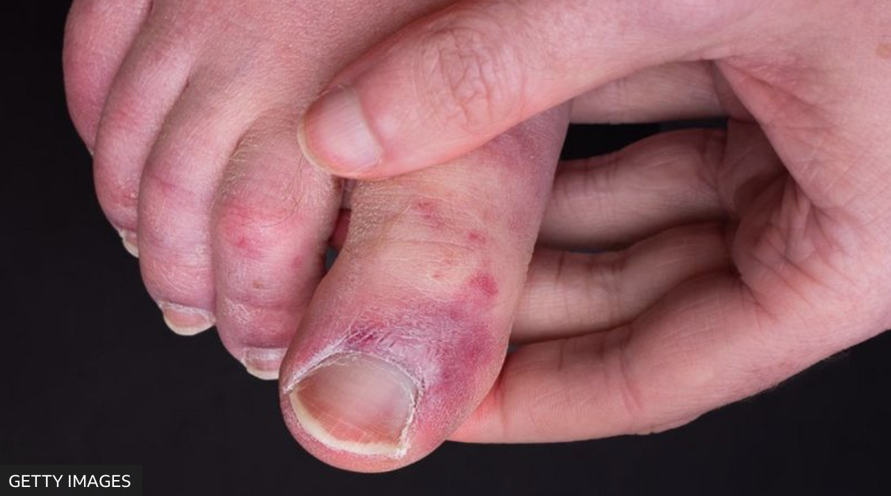 “Dedos de covid”: o raro sintoma que atinge mãos e pés